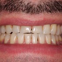 Composite Bonding - Smile 8 before